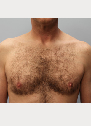 Before Image: Gynecomastia & Lipo-Dr. Howell - front