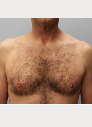 Gynecomastia & Lipo-Dr. Howell