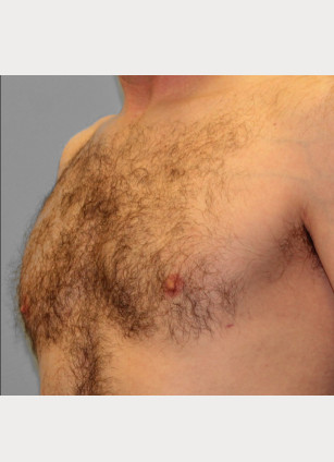 After Image: Gynecomastia & Lipo-Dr. Howell - left-front-oblique