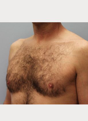 Before Image: Gynecomastia & Lipo-Dr. Howell - left-front-oblique