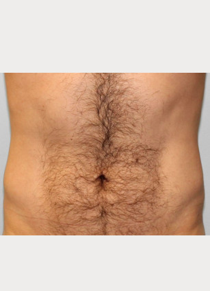 After Image: Gynecomastia & Lipo-Dr. Howell - front