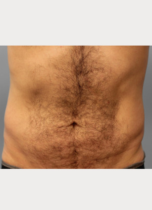 Before Image: Gynecomastia & Lipo-Dr. Howell - front