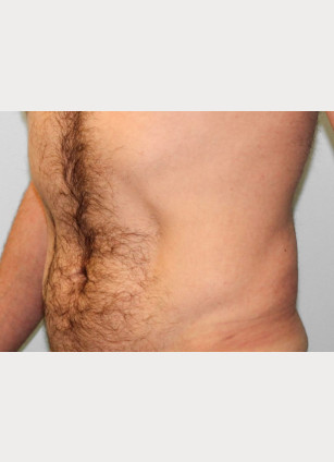 After Image: Gynecomastia & Lipo-Dr. Howell - left-front-oblique