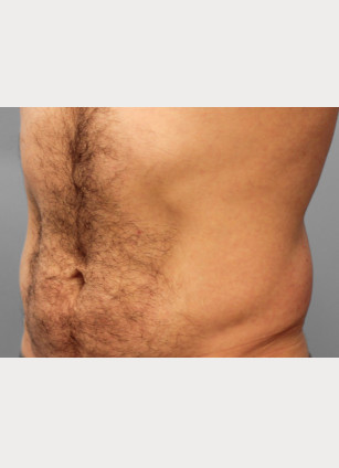 Before Image: Gynecomastia & Lipo-Dr. Howell - left-front-oblique