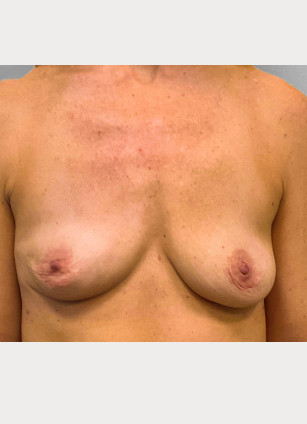 After Image: Breast Implant Removal- Dr. Tucker - front