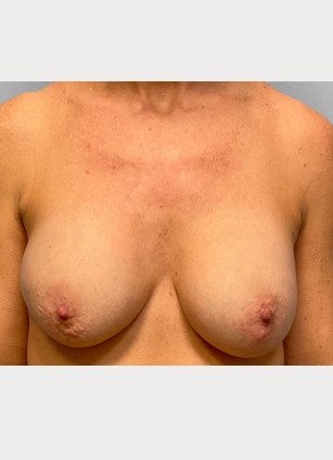 Before Image: Breast Implant Removal- Dr. Tucker - front