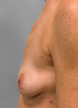 After Image: Breast Implant Removal- Dr. Tucker - left-side