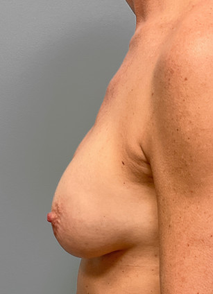 Before Image: Breast Implant Removal- Dr. Tucker - left-side