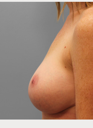 After Image: Mommy Makeover – Dr. Tucker - left-side
