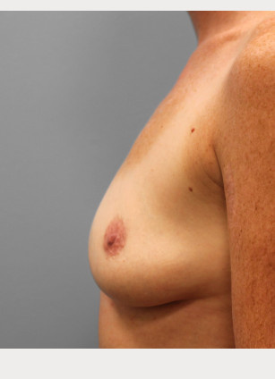 Before Image: Mommy Makeover – Dr. Tucker - left-side