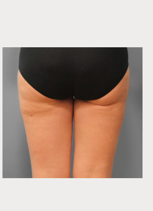 After Image: Mommy Makeover – Dr. Tucker - back