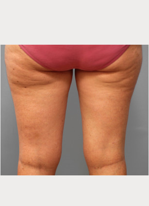 Before Image: Mommy Makeover – Dr. Tucker - back