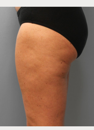 After Image: Mommy Makeover – Dr. Tucker - other
