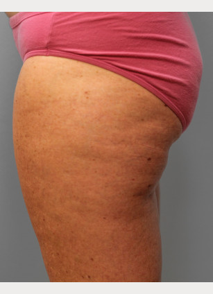 Before Image: Mommy Makeover – Dr. Tucker - other