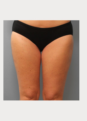 After Image: Mommy Makeover – Dr. Tucker - front