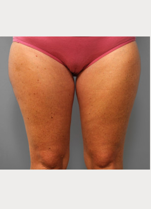 Before Image: Mommy Makeover – Dr. Tucker - front