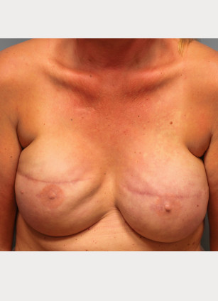 Before Image: Breast Reconstruction – Dr. Tucker - front