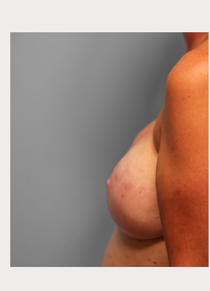 Before Image: Breast Reconstruction – Dr. Tucker - left-side