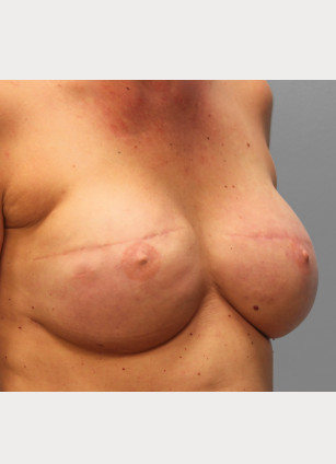 After Image: Breast Reconstruction – Dr. Tucker - right-front-oblique