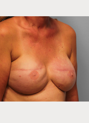 Before Image: Breast Reconstruction – Dr. Tucker - right-front-oblique
