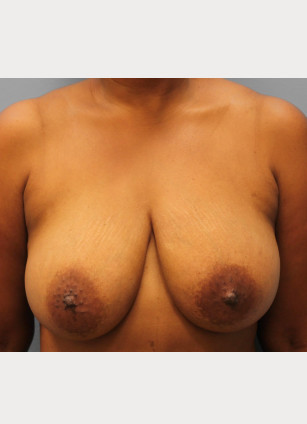 Before Image: Breast Reduction – Dr. Tucker - front