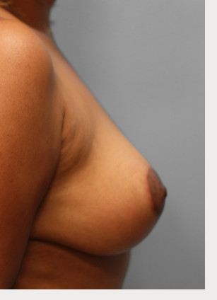 After Image: Breast Reduction – Dr. Tucker - right-side