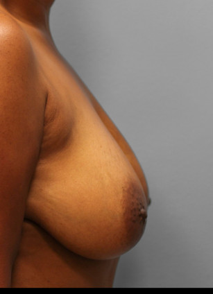 Before Image: Breast Reduction – Dr. Tucker - right-side