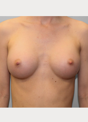 After Image: Breast Augmentation – Dr. Tucker - front
