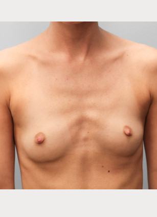 Before Image: Breast Augmentation – Dr. Tucker - front