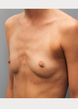 Before Image: Breast Augmentation – Dr. Tucker - left-front-oblique