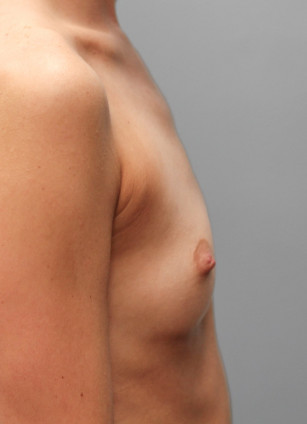Before Image: Breast Augmentation – Dr. Tucker - right-side