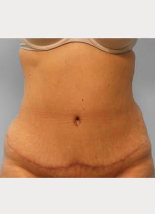 After Image: Abdominoplasty – Dr. Tucker - front