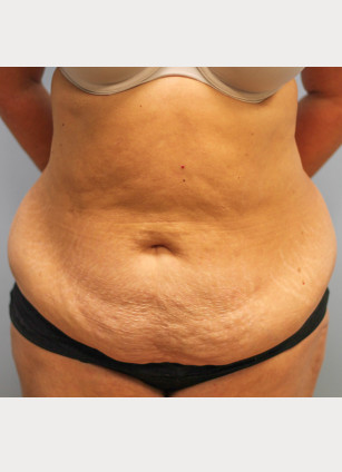 Before Image: Abdominoplasty – Dr. Tucker - front