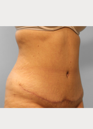 After Image: Abdominoplasty – Dr. Tucker - right-front-oblique