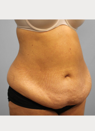 Before Image: Abdominoplasty – Dr. Tucker - right-front-oblique