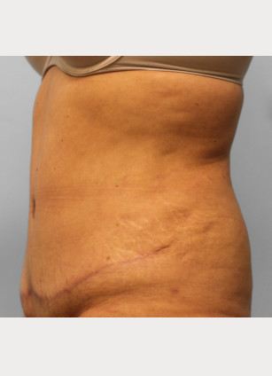 After Image: Abdominoplasty – Dr. Tucker - left-side