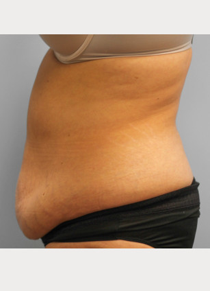 Before Image: Abdominoplasty – Dr. Tucker - left-side
