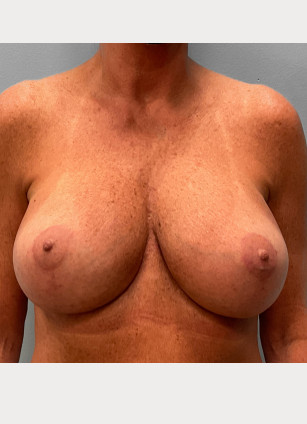 After Image: Breast Augmentation Revision – Dr. Tucker - front
