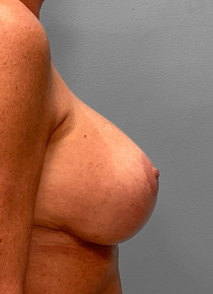After Image: Breast Augmentation Revision – Dr. Tucker - right-side