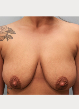 Before Image: Breast Augmentation – Dr. Tucker - front