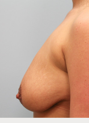 Before Image: Breast Augmentation – Dr. Tucker - left-side