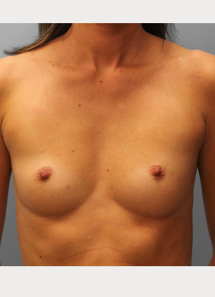 Before Image: Breast Augmentation – Dr. Tucker - front