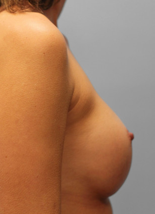After Image: Breast Augmentation – Dr. Tucker - right-side