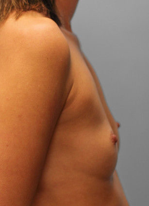 Before Image: Breast Augmentation – Dr. Tucker - right-side