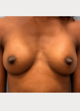 After Image: Breast Augmentation – Dr. Tucker - front