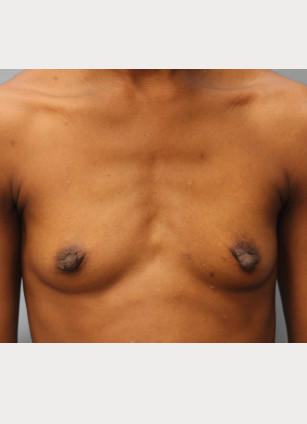 Before Image: Breast Augmentation – Dr. Tucker - front