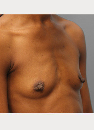 Before Image: Breast Augmentation – Dr. Tucker - right-front-oblique