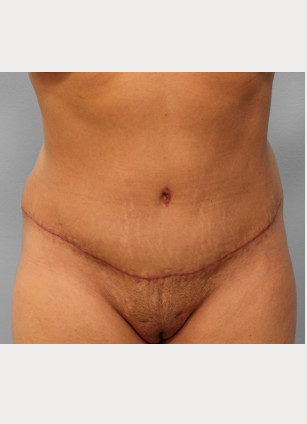 After Image: Abdominoplasty & Lipo – Dr. Tucker - front