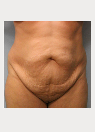 Before Image: Abdominoplasty & Lipo – Dr. Tucker - front