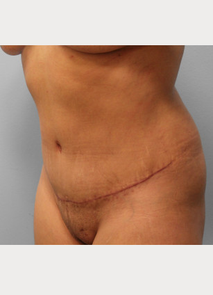 After Image: Abdominoplasty & Lipo – Dr. Tucker - left-front-oblique